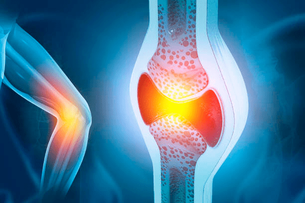 Prevencia kĺbových ochorení