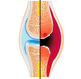Štruktúra zdravého a opotrebovaného kĺbu s označením tkaniva chrupavky a synoviálnej tekutiny